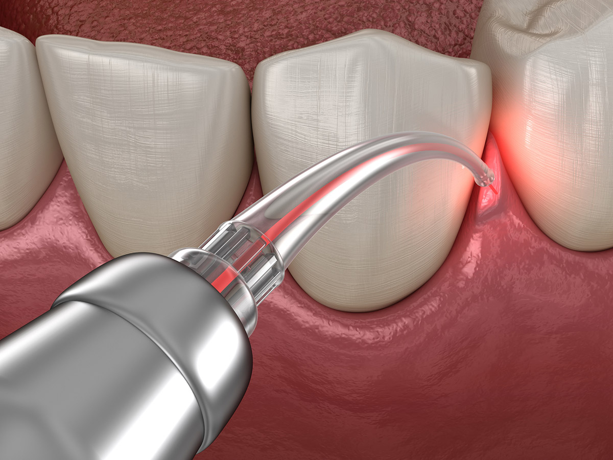 Laser Gum Treatment Example