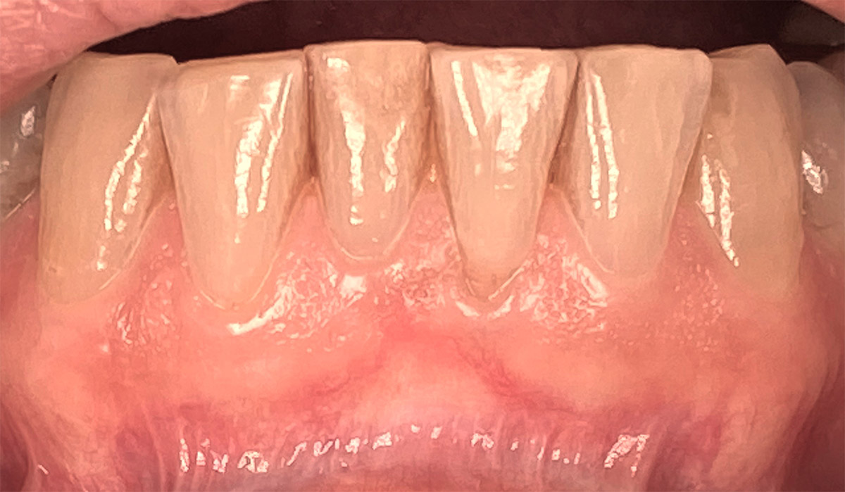 After Laser Gum Treatment